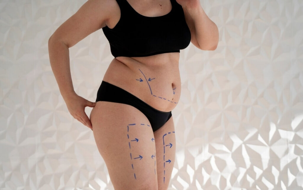 liposucción sin cirugía