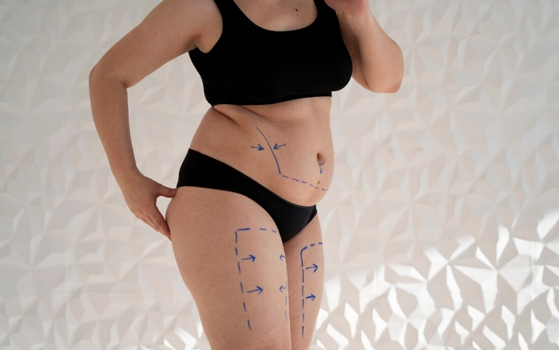 liposucción sin cirugía